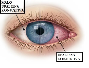 Slika prikaza kako izgleda konjuktivitis