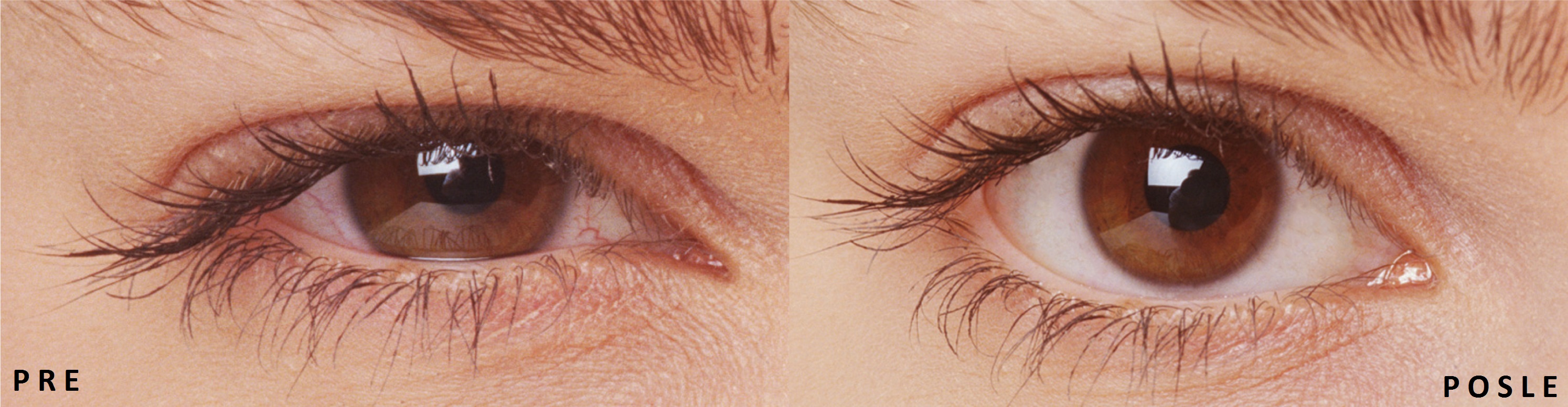 Pre i posle - Iritacija i sindrom suvog oka