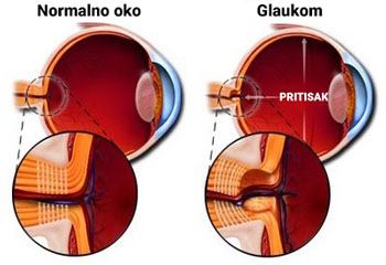 Prikaz kako izgleda normalno oko i oko sa glaukomom