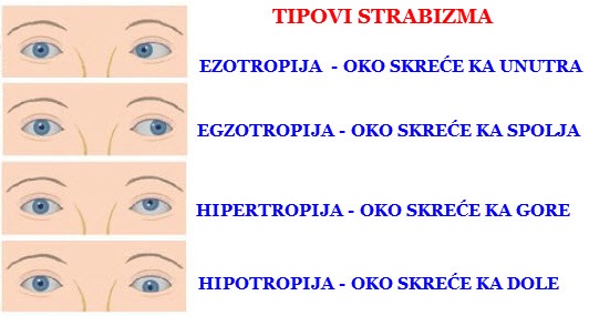 Tipovi strabizma